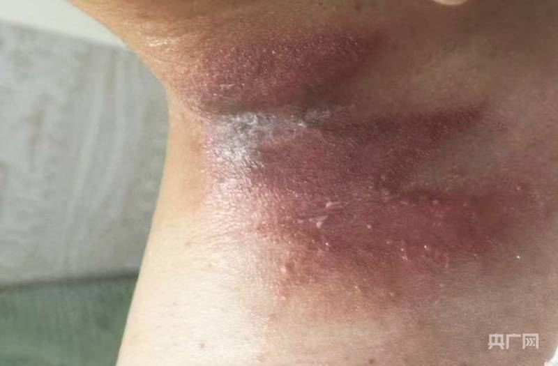 河南多地出现隐翅虫 医生提醒：保持室内清洁 发现切勿拍打